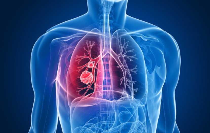 “Podría ser EPOC”: lanzan la Campaña Nacional de Concientización sobre la Enfermedad Pulmonar Obstructiva Crónica – La Ciudad Avellaneda “Podría ser EPOC”: lanzan la Campaña Nacional de Concientización sobre la Enfermedad Pulmonar Obstructiva Crónica – La Ciudad Avellaneda